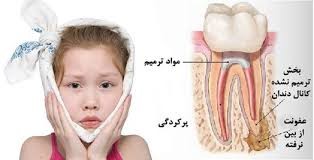 دندان درد + پوسیدگی روی دندان +درمان - ویجیاتو